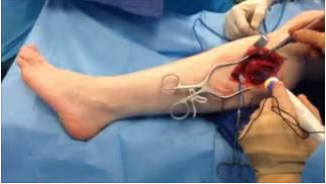 Peripheral Nerve Stimulation Video