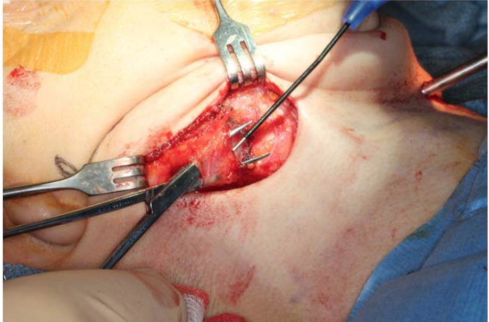 Facial Nerve Injury Following TMJ Surgery and its Management by